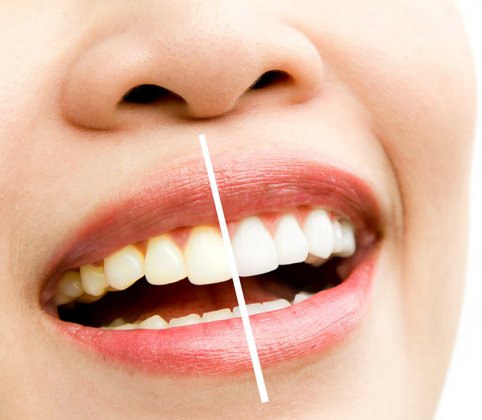 Zahnaufhellung & Mundhygiene – Tipps für ein strahlendes Lächeln